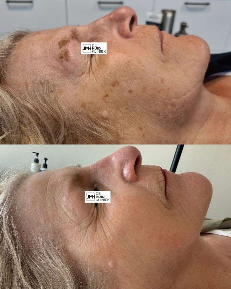 gezicht laseren pigment