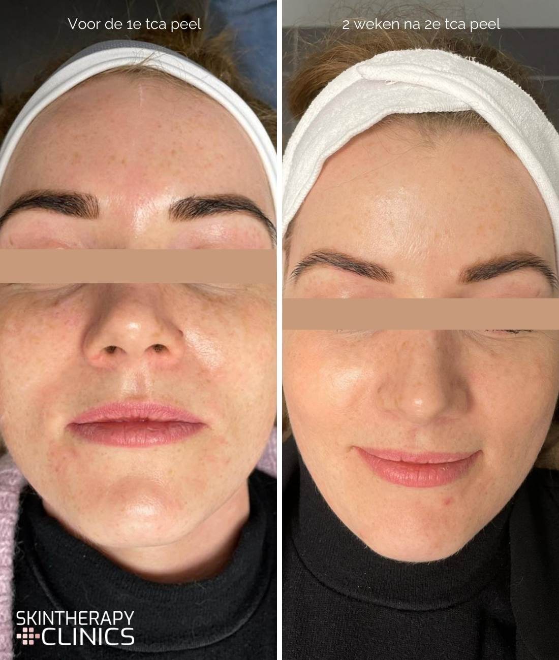 huid peeling behandeling