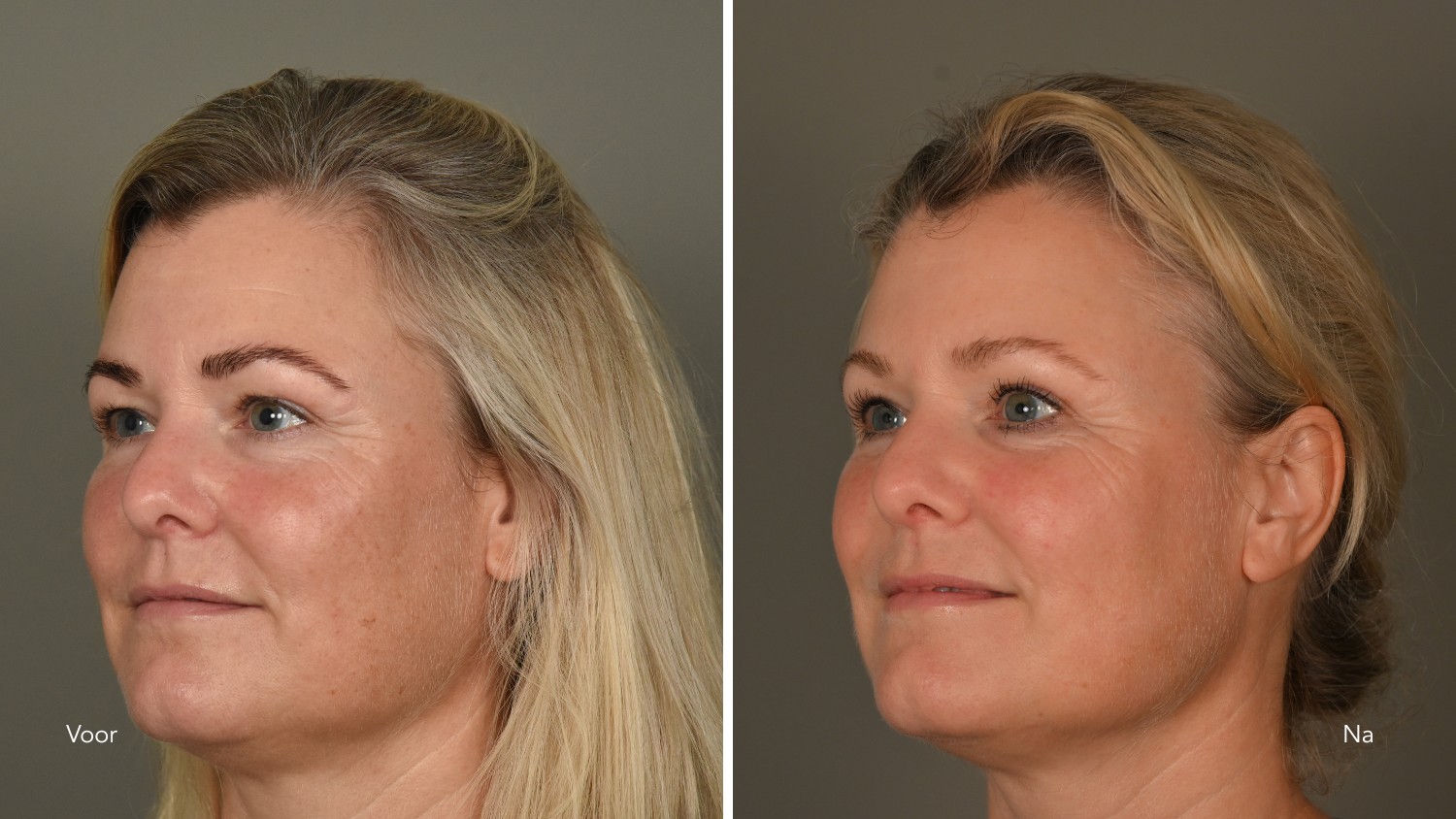 kosten laserbehandeling pigmentvlekken