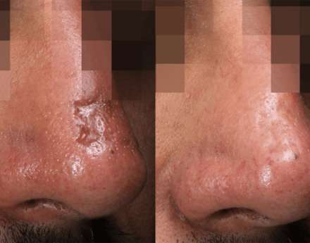 laserbehandeling acne littekens prijs