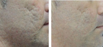 litteken laseren voor en na