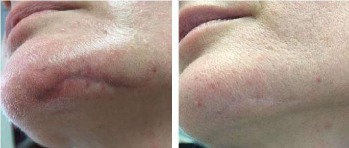 litteken weg laseren