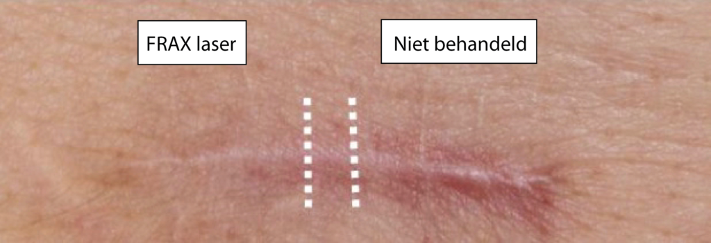 littekens gezicht laseren