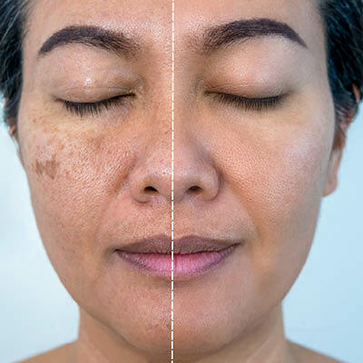 pigmentvlekken door laserbehandeling