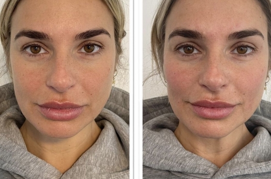 fillers voor en na