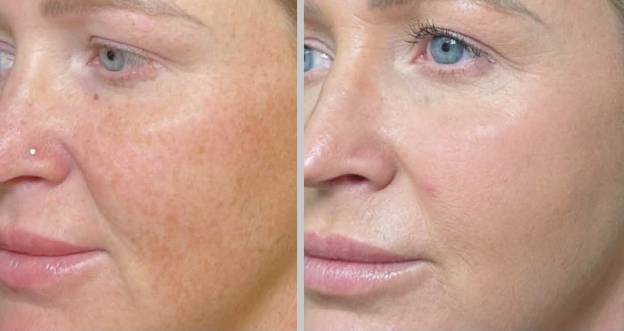 gezichtsbehandeling met laser