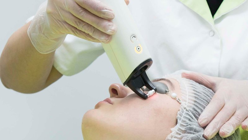 huidverjonging door laser