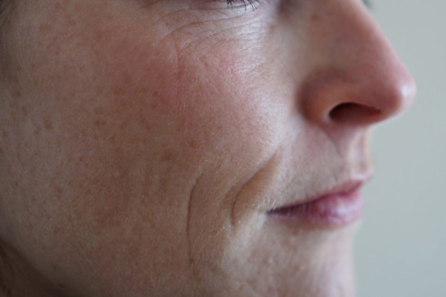 huidverjonging laser ervaringen