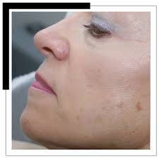 laserbehandeling huidverjonging