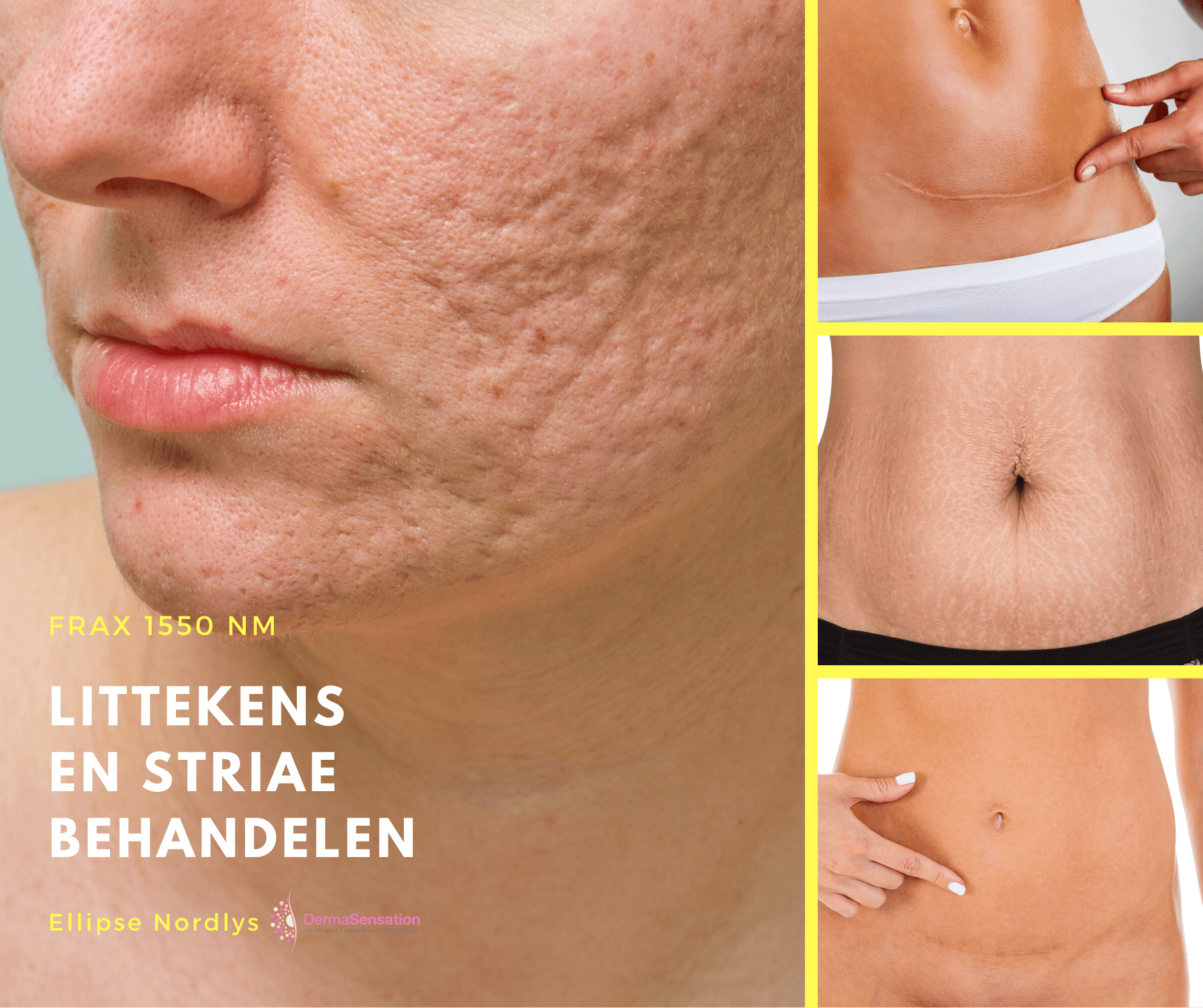 laserbehandeling littekens prijs