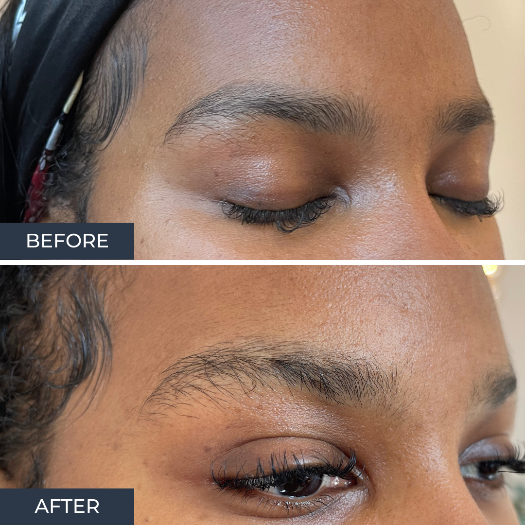 laserbehandeling pigmentvlekken gezicht prijs