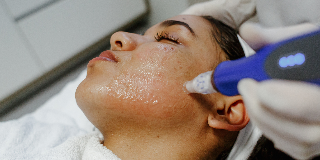 microneedling behandeling