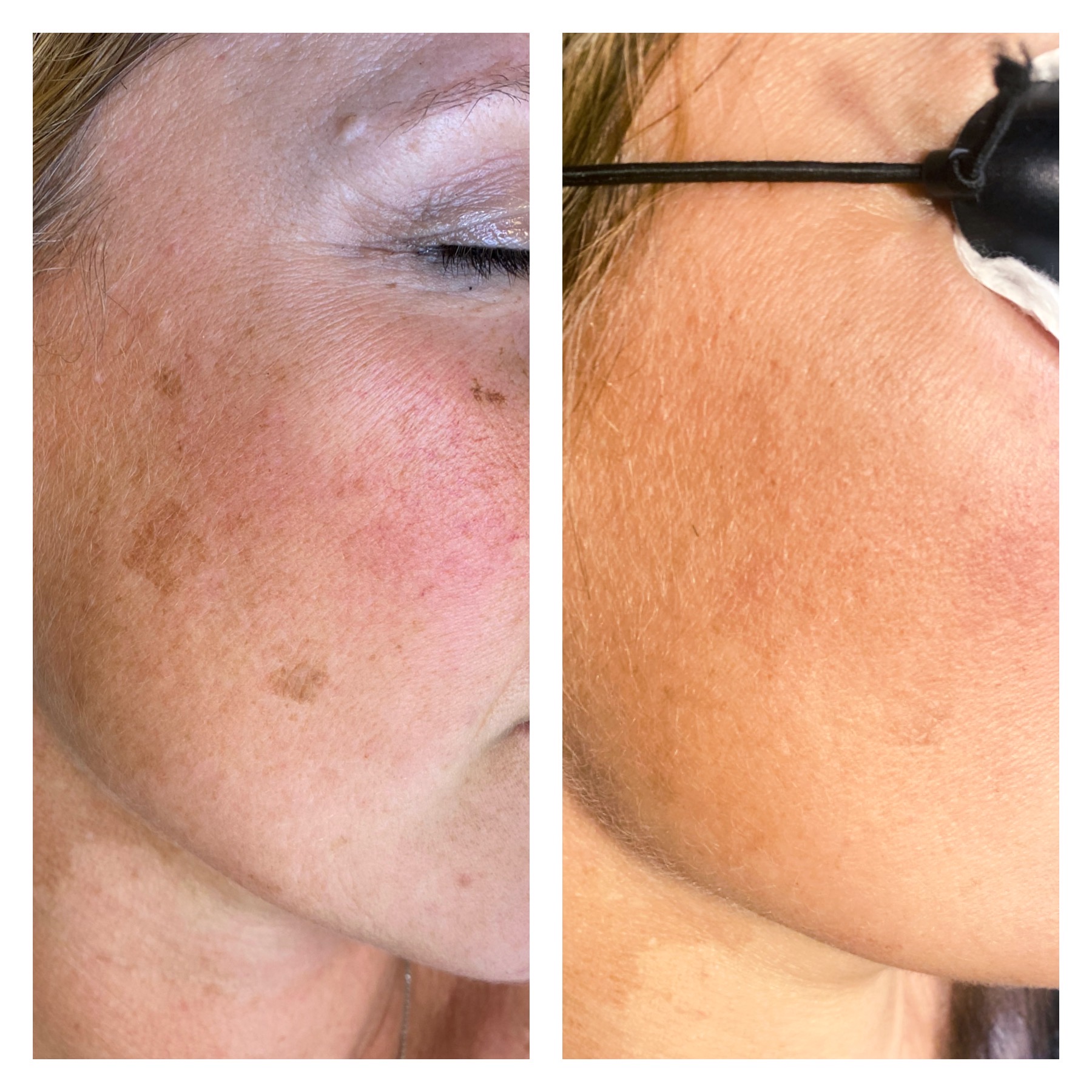 pigment laseren kosten