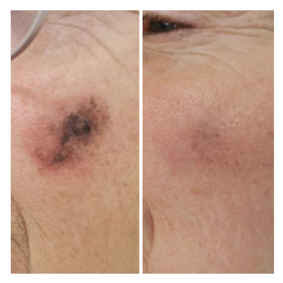 pigmentvlekken door laseren