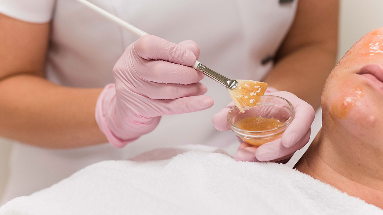 chemisch peeling kosten
