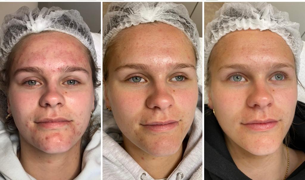 fruitzuurpeeling acne