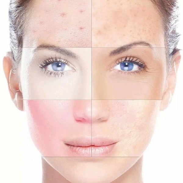 gezichtsbehandeling microdermabrasie