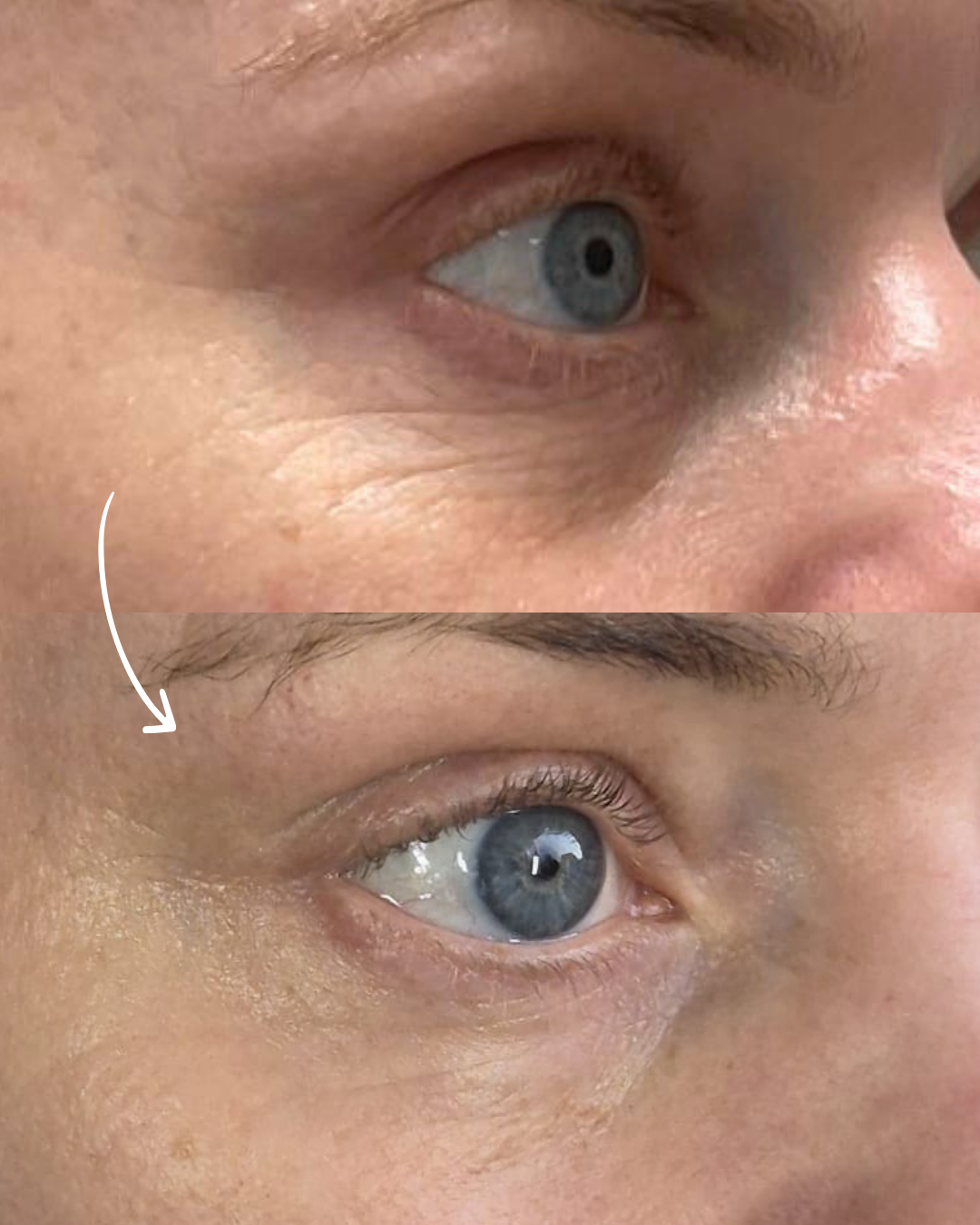 huidverjonging co2 laser