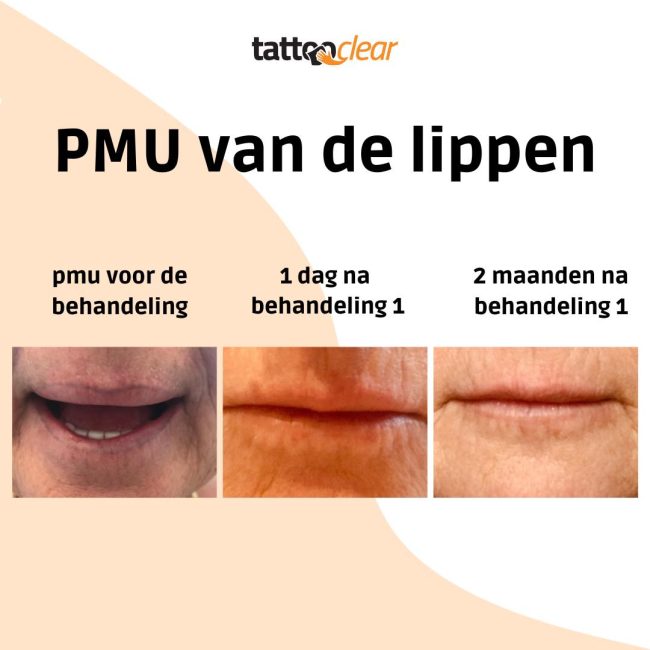laserbehandeling bovenlip