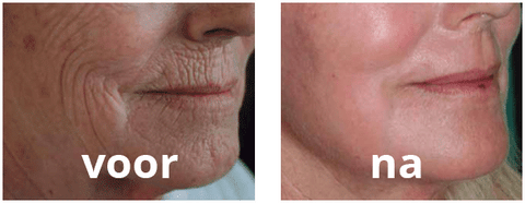 chemische peeling rtl boulevard