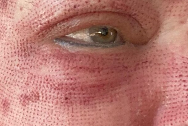gezicht laser behandeling