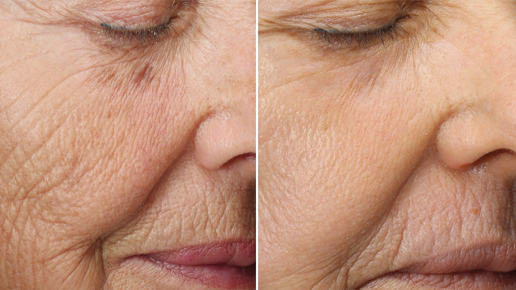 chemische peeling antwerpen