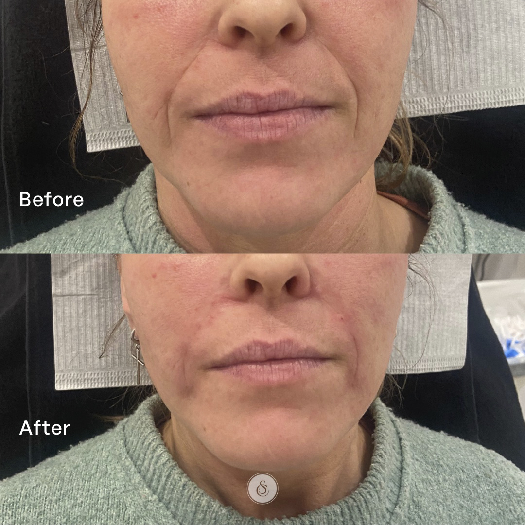 fillers mondhoeken voor en na