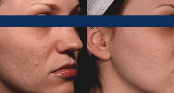 acne laserbehandeling