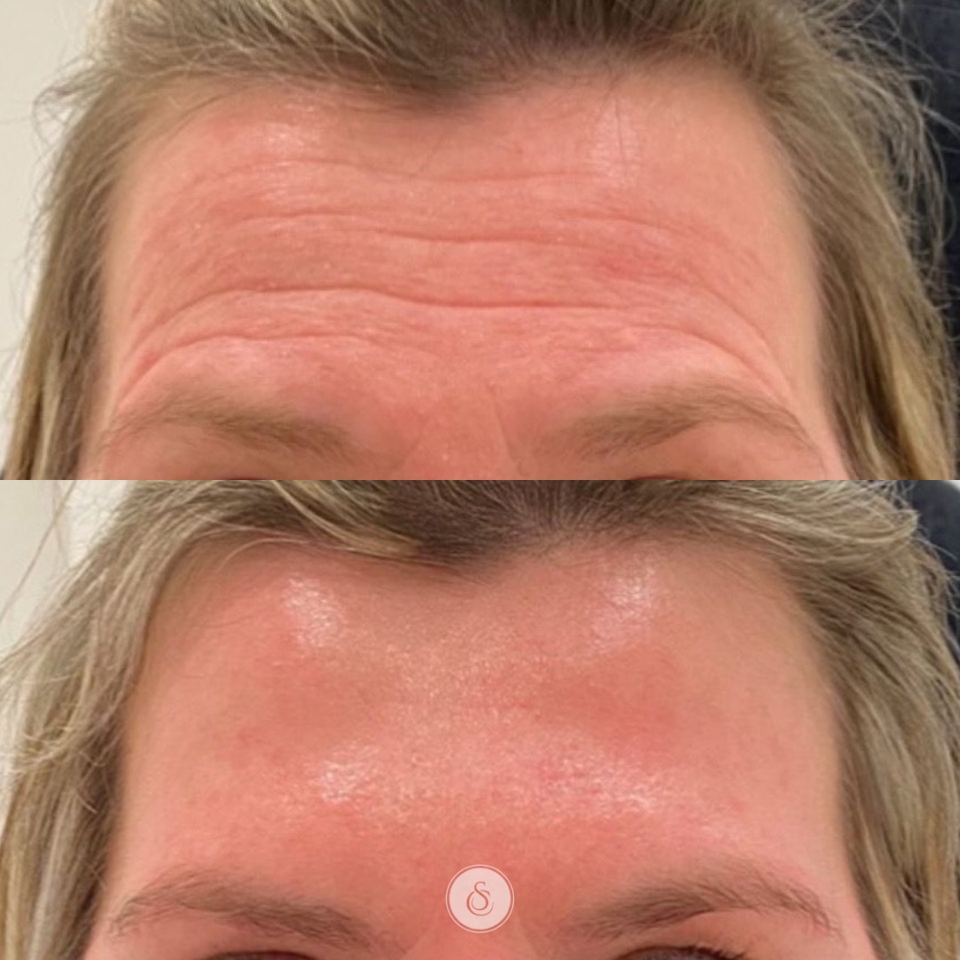 botox filler