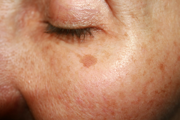 ipl laser pigmentvlekken