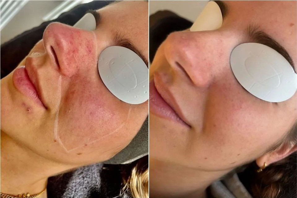 laser behandeling