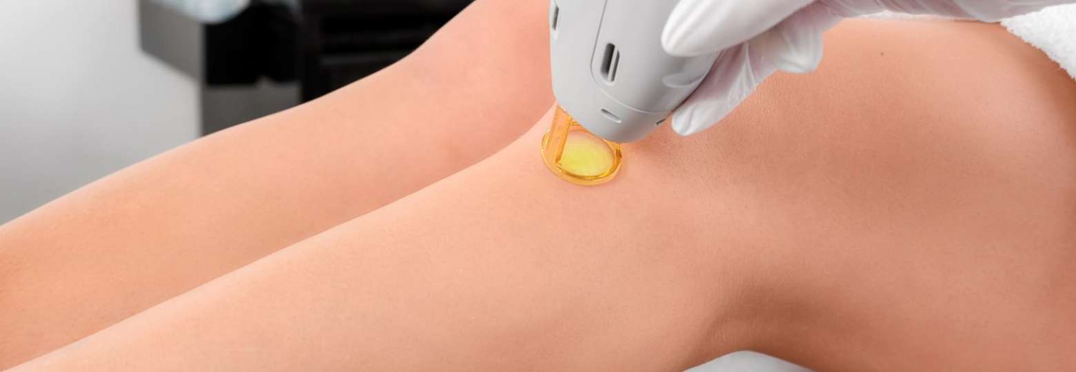 laser behandelingen