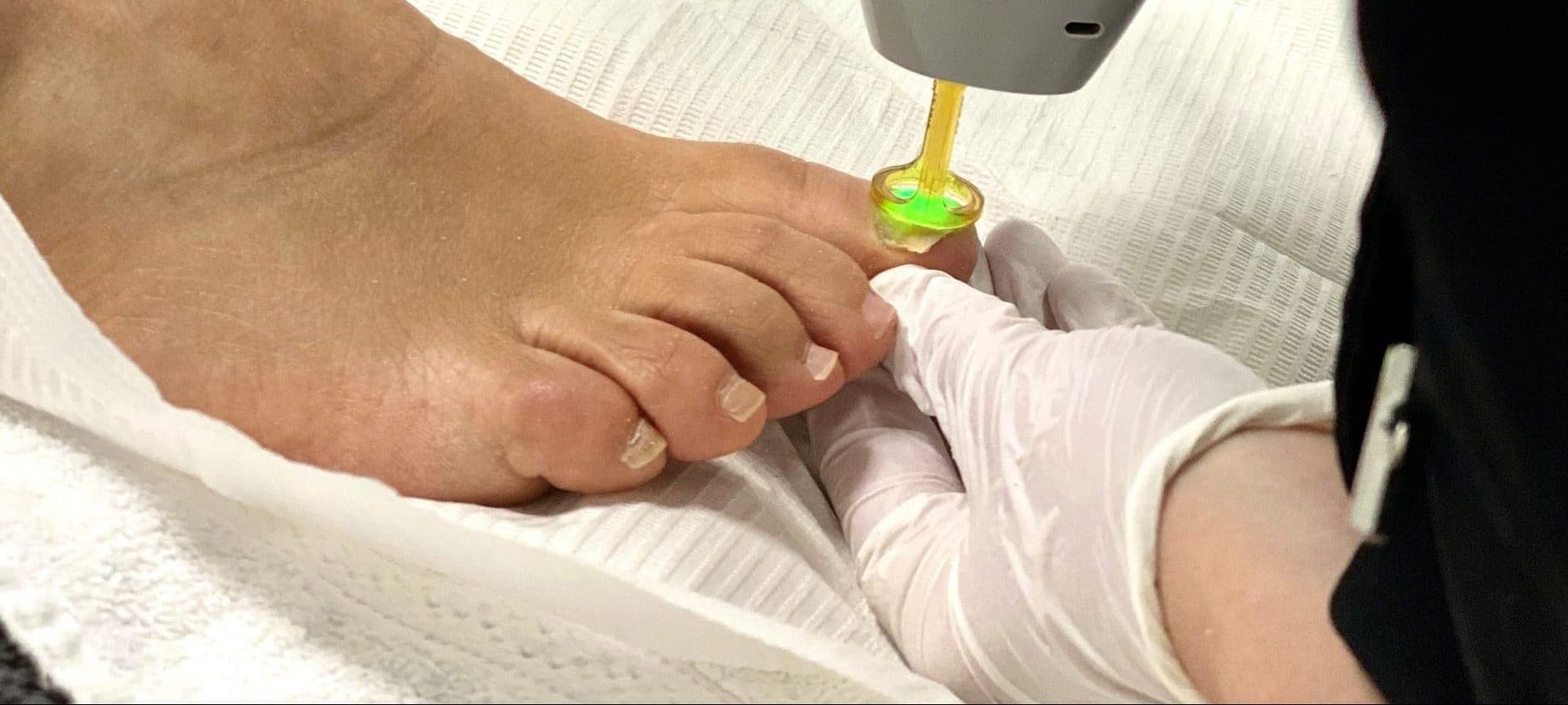 laserbehandeling schimmelnagel