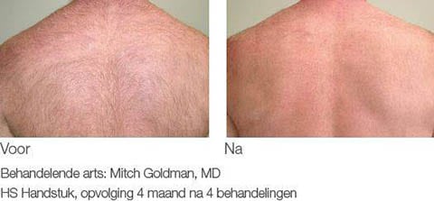 ontharen met diode laser