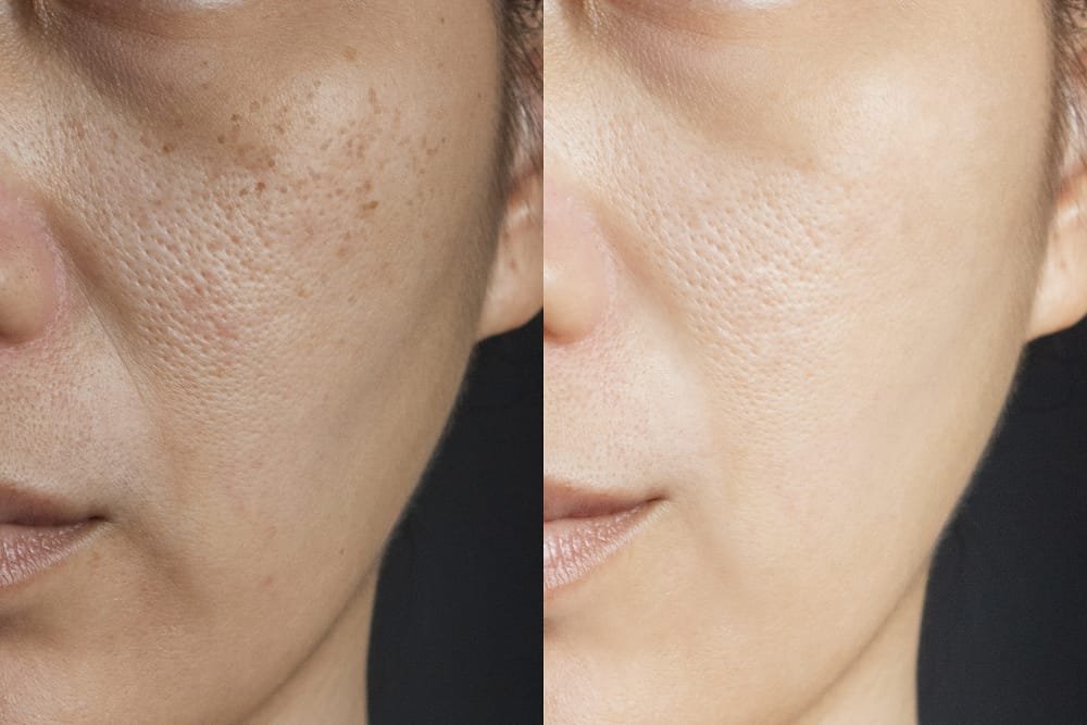 tca peeling